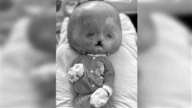 馬來西亞,居林,大頭症娃娃,無葉前腦無裂畸形症,Alobar Holoprosencephaly,病逝
