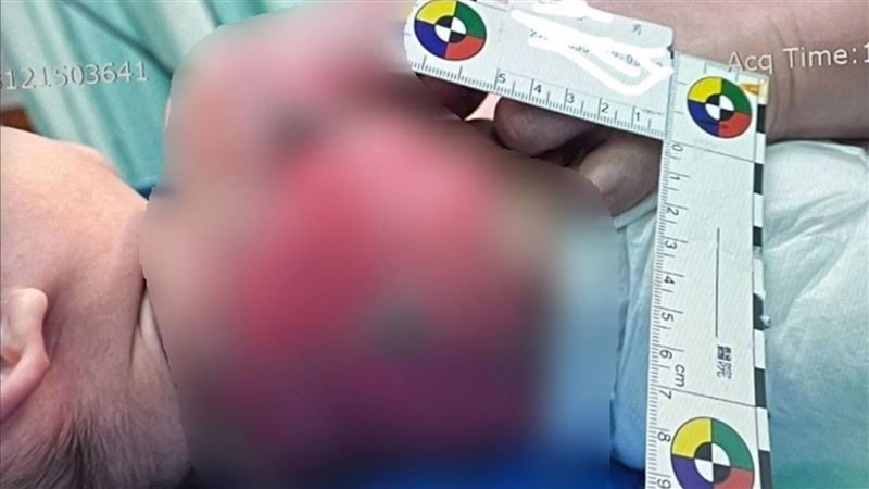 男嬰遭燙傷無影像？衛福部：最重可罰30萬