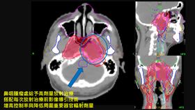 患者使用影像導引合併螺旋刀技術治療鼻咽癌。（圖／亞東醫院提供）