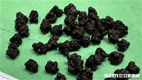 膽結石／黃漢斌醫師授權提供