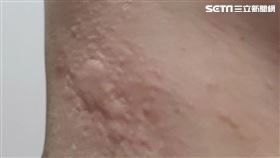蕁麻疹。（圖／記者陳韋帆攝影）
