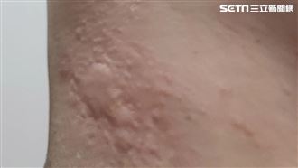 高中男等公車!突臉浮腫、氣喘 醫揭元凶