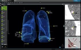 北榮桃園分院肺癌篩檢結合AI技術　實現智能化檢查服務（圖／桃園電子報）