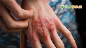 蘇桂英醫師表示，乾癬性關節炎與基因體質、後天環境有關，好發於30至50歲的族群，多數患者是早年有乾癬，過了10幾年才發生關節問題。