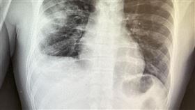 ▲30多歲年輕人染流感「肺塌陷」險沒呼吸。（圖／翻攝自姜冠宇醫師臉書）

