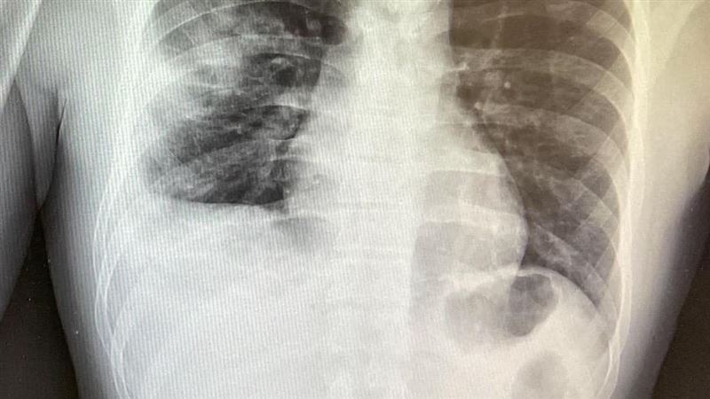 30多歲年輕人染流感 「肺塌陷」險沒呼吸