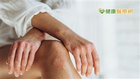 楊翔宇醫師表示，乾癬無法根治，需要長期穩定控制，使用生物製劑的優勢在於安全性高，長期使用較無身體疑慮。