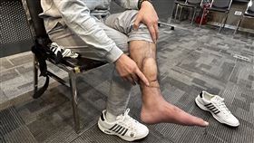 吳先生掀起褲管，露出腿部縫合傷口痕跡。（圖／記者簡浩正攝影）