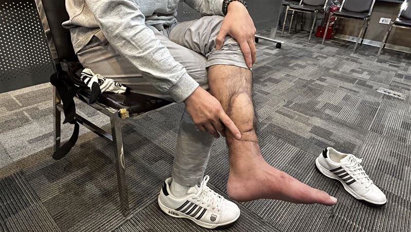 他被螺旋槳截斷左小腿！長庚醫12小時接回