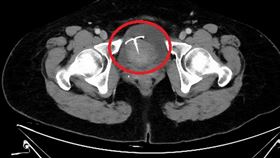 電腦斷層影像顯示避孕器已經穿透子宮，須執行子宮開腹切除術將子宮摘除。（圖／台北慈濟醫院提供）