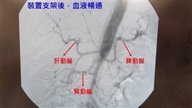 主動脈剝離,肚痛,背痛,急診（圖／中醫大新竹附醫提供）
