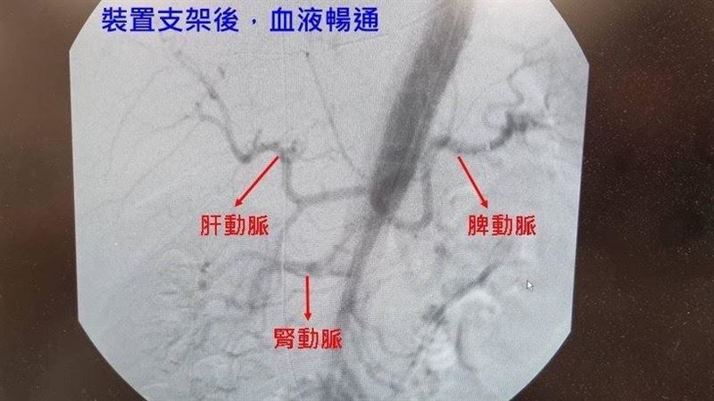 新竹男腹痛急診！肝腎缺血「這病」險要命
