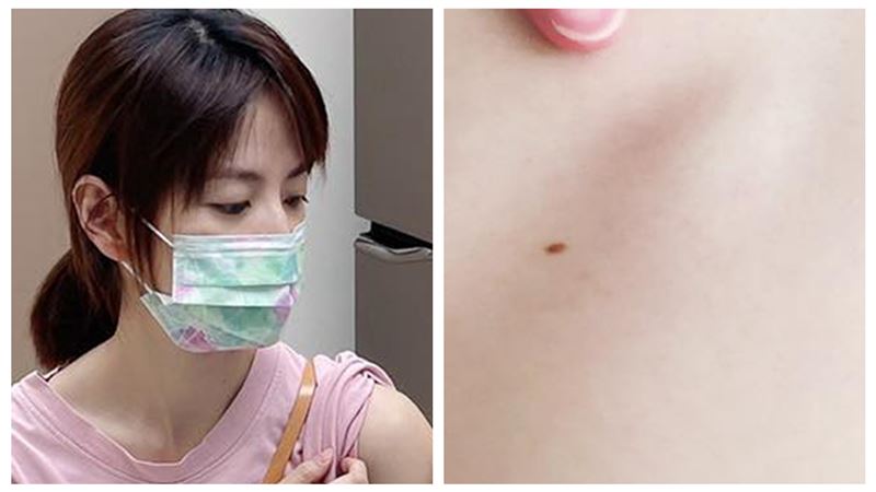 《食尚》女星痣變大變黑　割除化驗是惡性