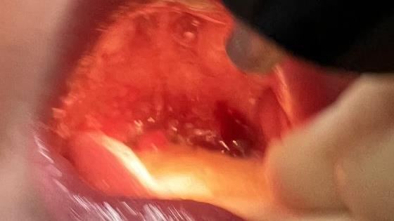 腸病毒肆虐　1歲童高39.2度喉嚨水泡爆裂