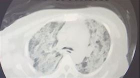 流感,肺臟,醫生,症狀