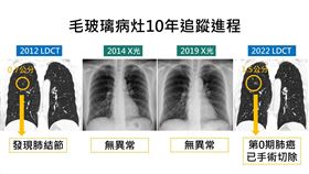 低劑量電腦斷層(門諾醫院)
