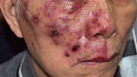 ▲帶狀疱疹會沿著神經節擴散、蔓延。（圖／雙和醫院提供）