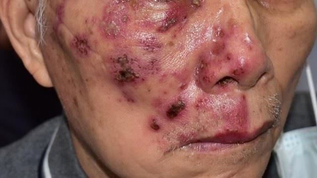 7旬嬤皮膚乾猛擦乳液竟「臉爛」皮蛇惹禍