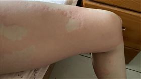 蕁麻疹/衛福部南投醫院中醫科賴卉蓮醫師(南投醫院提供)