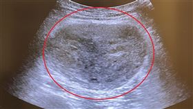 0204惡性黏液纖維肉瘤(亞大醫院提供)