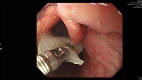 0204豬軟骨(北市聯醫提供)