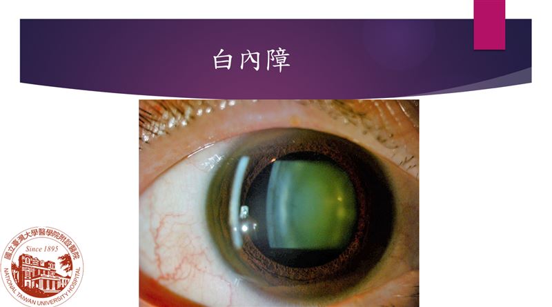 吸菸傷眼！台大醫：恐罹6大眼疾甚至失明