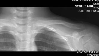 北市小學驚傳集體霸凌　小一男童遭毆骨折