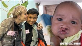 【印尼跨國醫療外交】記者張雅筑攝、羅慧夫顱顏基金會授權提供