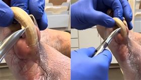 一名病患的指甲宛如惡魔角。（圖／翻攝自抖音）