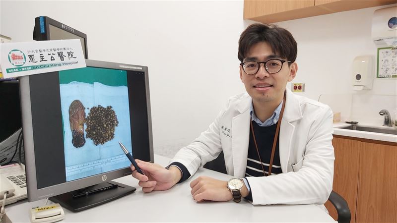這不是佛珠！9旬老翁清出「滿盆」膽結石