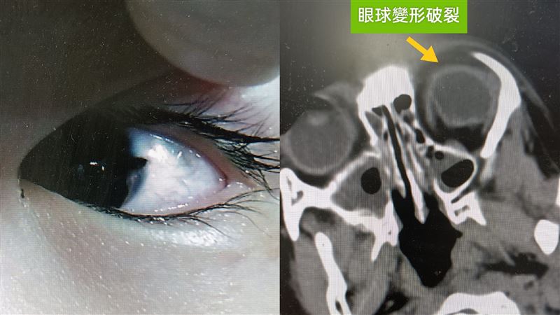 以為美工刀是筆！4歲童「眼球被劃破」