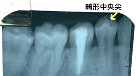 畸形中央尖(北市聯醫提供)