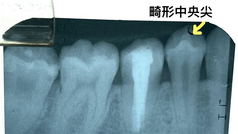 咬起來「怪怪的」　竟是臼齒長畸形中央尖