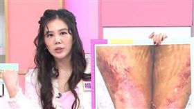 楊晨熙透露曾使用體雕加強按摩，結果竟全身瘀血。（圖／TVBS提供）