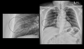 流感疫情恐再迎高點！40歲男咳到胸口劇痛　X光一照：肋骨斷掉了。蘇一峰臉書