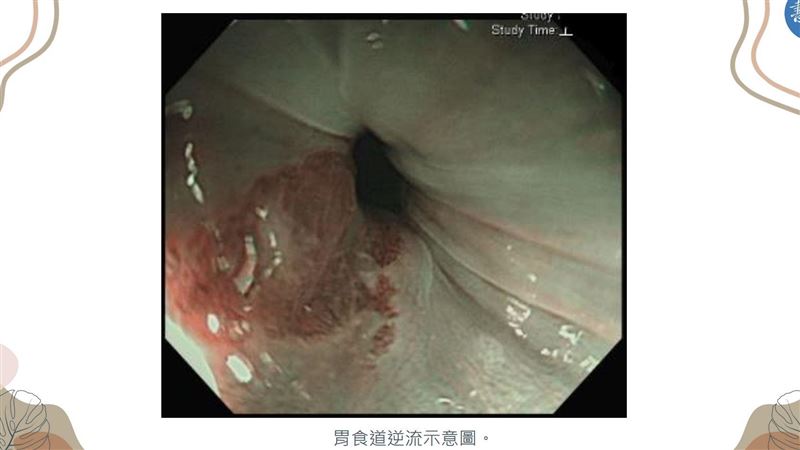 你也「烏龜頸」？30歲女胃食道逆流、便秘