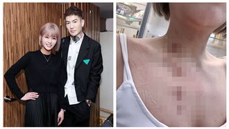李明珊直播出意外　胸脖熱油噴濺二度燙傷