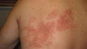 皮膚長痘痘，前胸蔓延到後背，「皮蛇」帶狀疱疹 (示意圖／林新醫院提供)