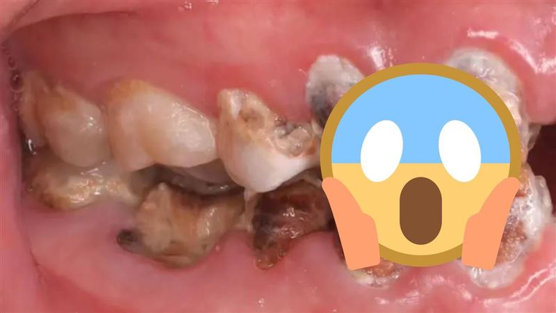 可樂當水喝1年 22歲女牙齒全黑一咬就掉