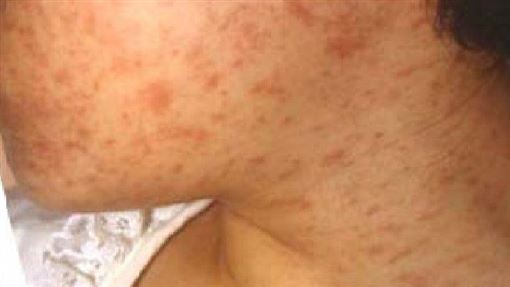 新／新北增1例麻疹 足跡曝光「曾搭捷運」