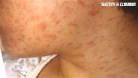 麻疹
圖／翻攝自台中市政府官網
https://www.taichung.gov.tw/8868/8872/9962/867938/post