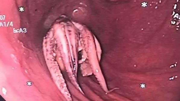 男食道挖出「整隻章魚」　觸手卡死畫面曝