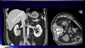 郭先生61歲時意外發現右側腎臟有一個3公分的腫瘤。（圖／記者簡浩正攝影）