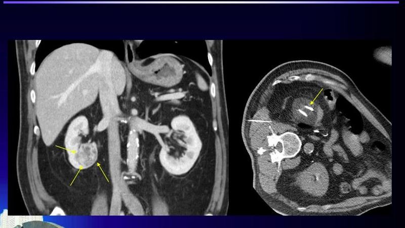 腹痛就醫竟腎癌！北榮「凍」死老翁癌細胞