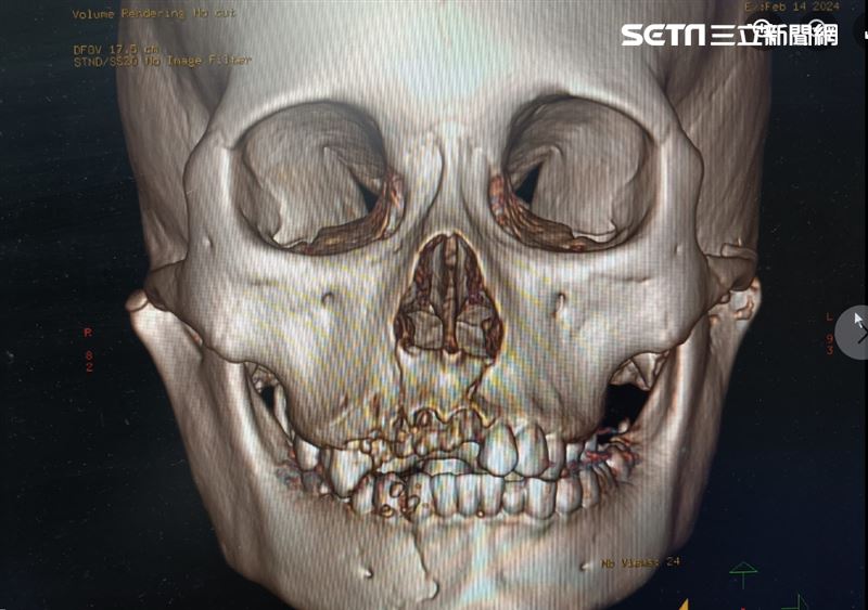 13歲少女半夜偷跑出門爸媽不知，騎車自撞電線桿後全臉骨折骨頭碎成拼圖狀。（圖／翻攝自黃士倫醫師粉專）