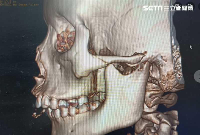 少女半夜偷騎爸媽的機車外出，撞上一旁的電線桿，造成臉部重大創傷，除了顏面骨碎成拼圖，大腿也開放性骨折，牙齒全排撞斷下巴也碎了。（圖／翻攝自黃士倫醫師粉專）