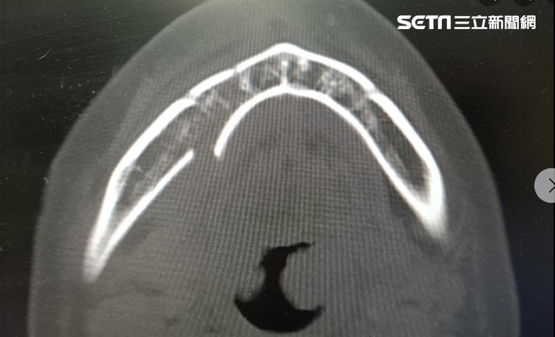 少女半夜偷騎爸媽的機車外出，撞上一旁的電線桿，造成臉部重大創傷，除了顏面骨碎成拼圖，大腿也開放性骨折，牙齒全排撞斷下巴也碎了。（圖／翻攝自黃士倫醫師粉專）