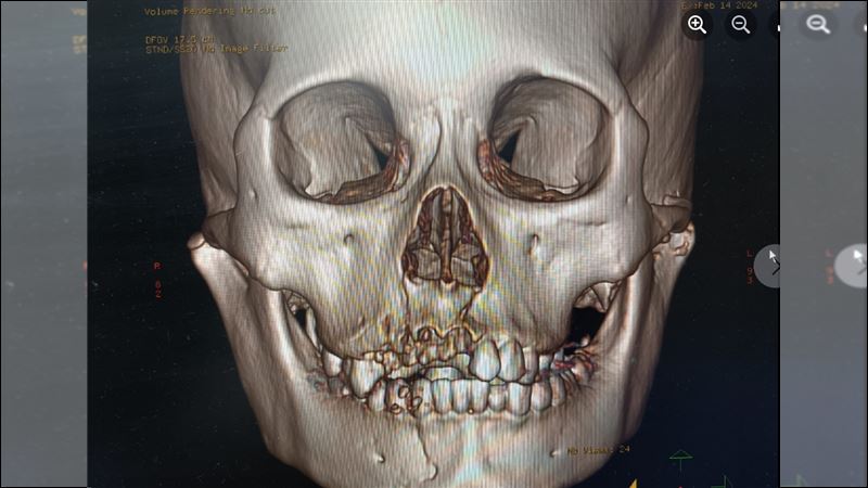 警世X光照片超痛！13歲少女半夜偷騎機車外出慘撞　顏面骨碎成拼圖