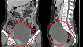 電腦斷層顯示家芸的腹部內有一顆16公分的巨大卵巢腫瘤。（圖／翻攝自花蓮慈濟醫院臉書）