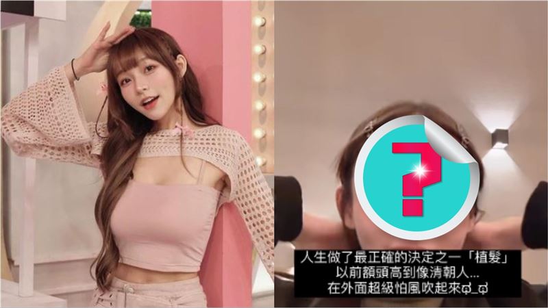 林襄掰了「清朝人額頭」！掀瀏海認植髮了
